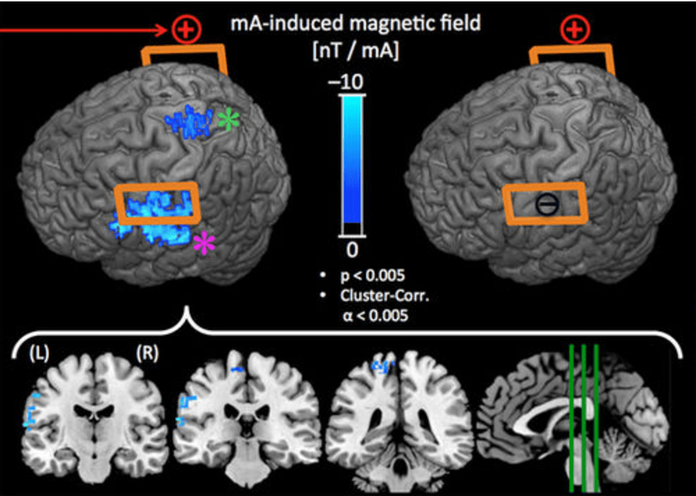 MRI cattura in tempo reale gli effetti della stimolazione elettrica del cervello