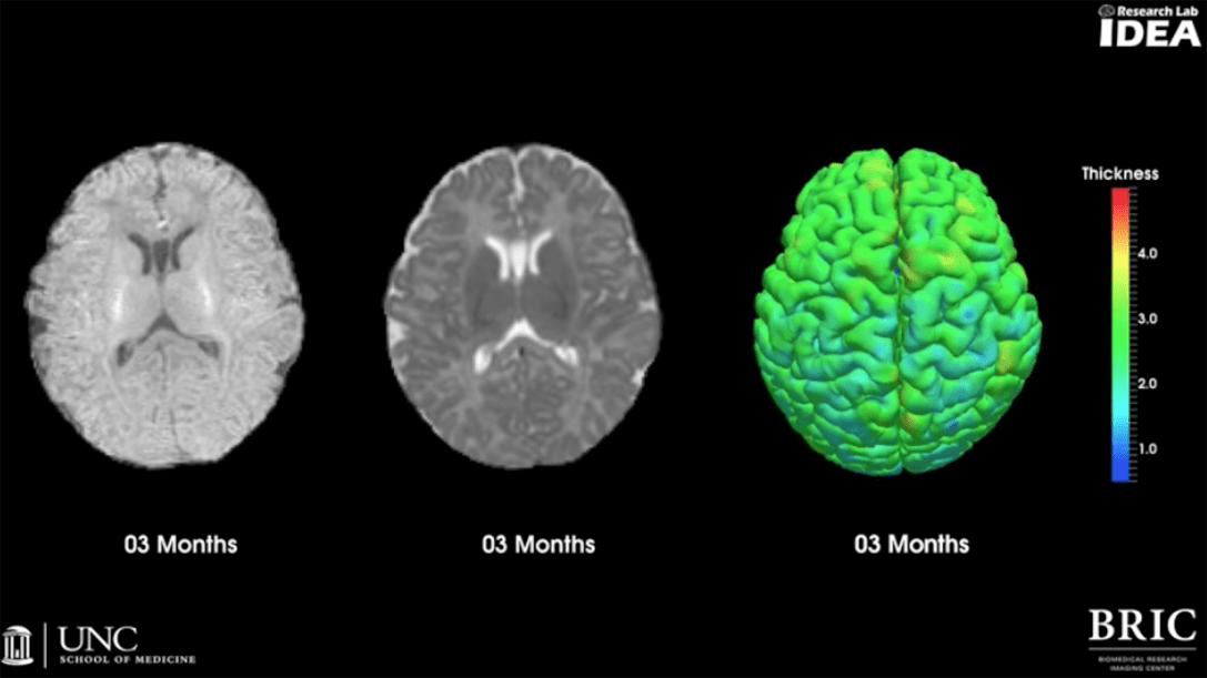 MRI e lo sviluppo del cervello nei bambini